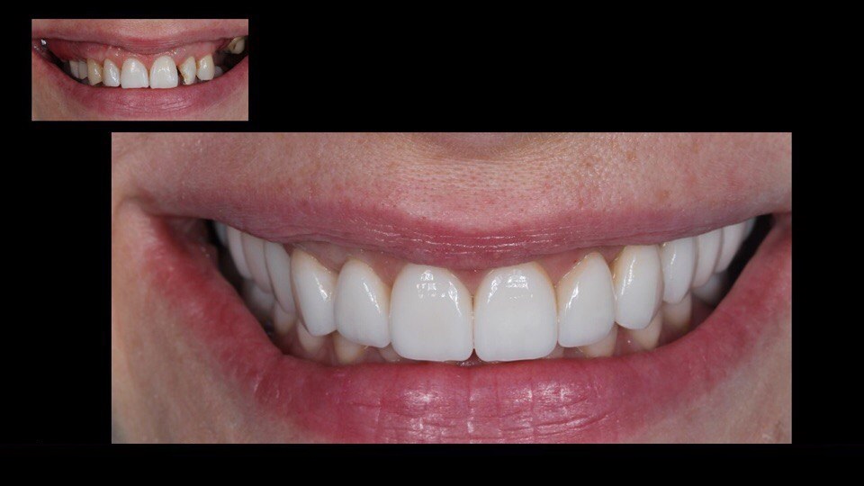 До и после. Эстетическая реставрация зубного ряда с помощью виниров. Отличить микропротез от естественного зуба практически невозможно.