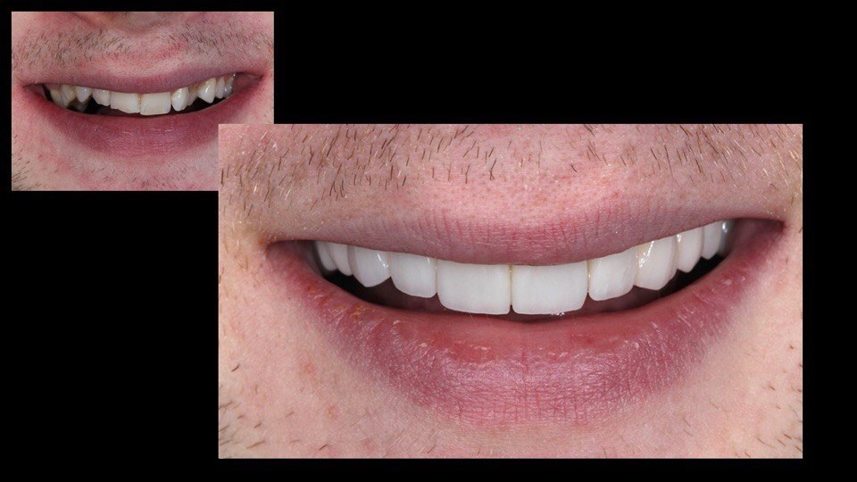 Толщина винира сопоставима с контактной линзой. Именно поэтому не требуется шлифовки зубов глубже толщины эмали.
